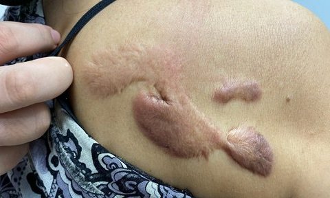 Người phụ nữ gánh tật vì cú lừa của spa