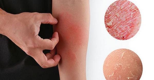 Bài thuốc chữa bệnh ngoài da do lạnh
