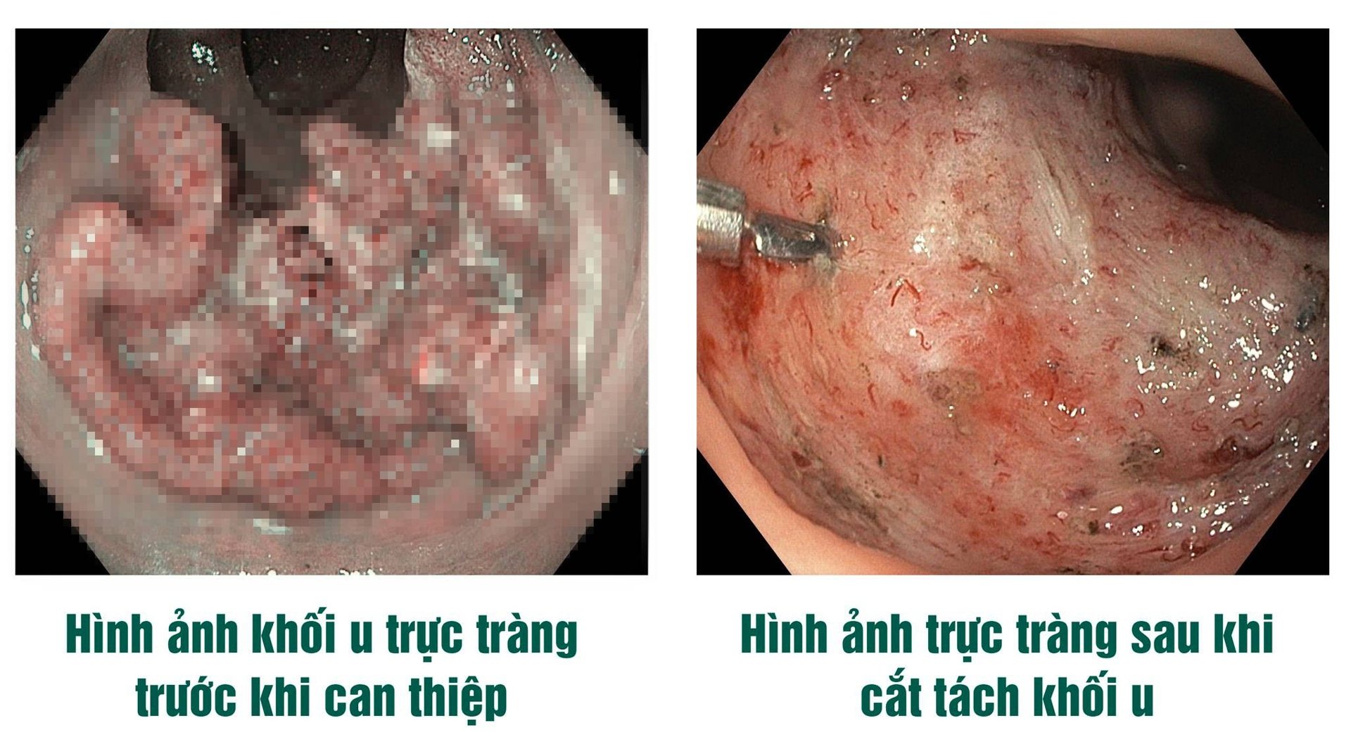 Phát hiện khối u trực tràng khổng lồ trong lần khám sức khoẻ định kỳ