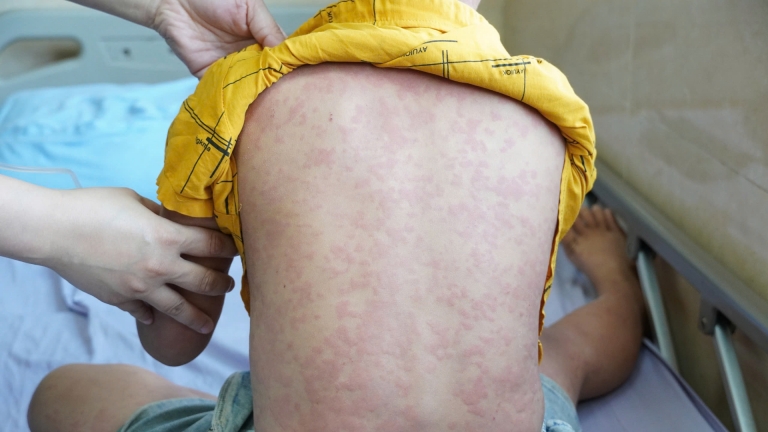 Bé trai nhập viện khẩn cấp do mày đay nhiễm khuẩn
